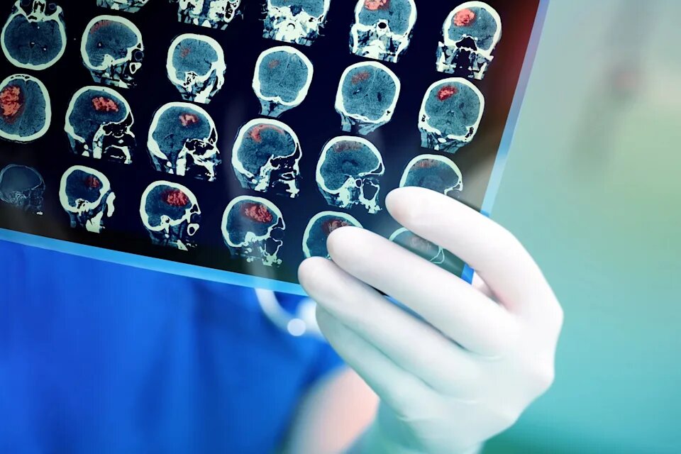 یک عامل نادیده گرفته شده که با تومورهای مغزی ارتباط دارد_68ad4a1c6d020.jpeg